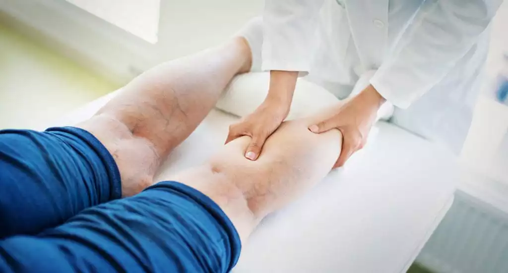 Treatment Options for Varicose Veins | Burt's Pharmacy and Compounding Lab