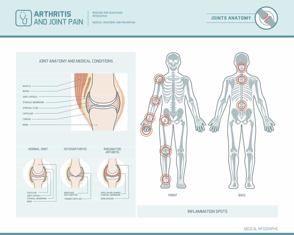 Different Types Of Arthritis Names