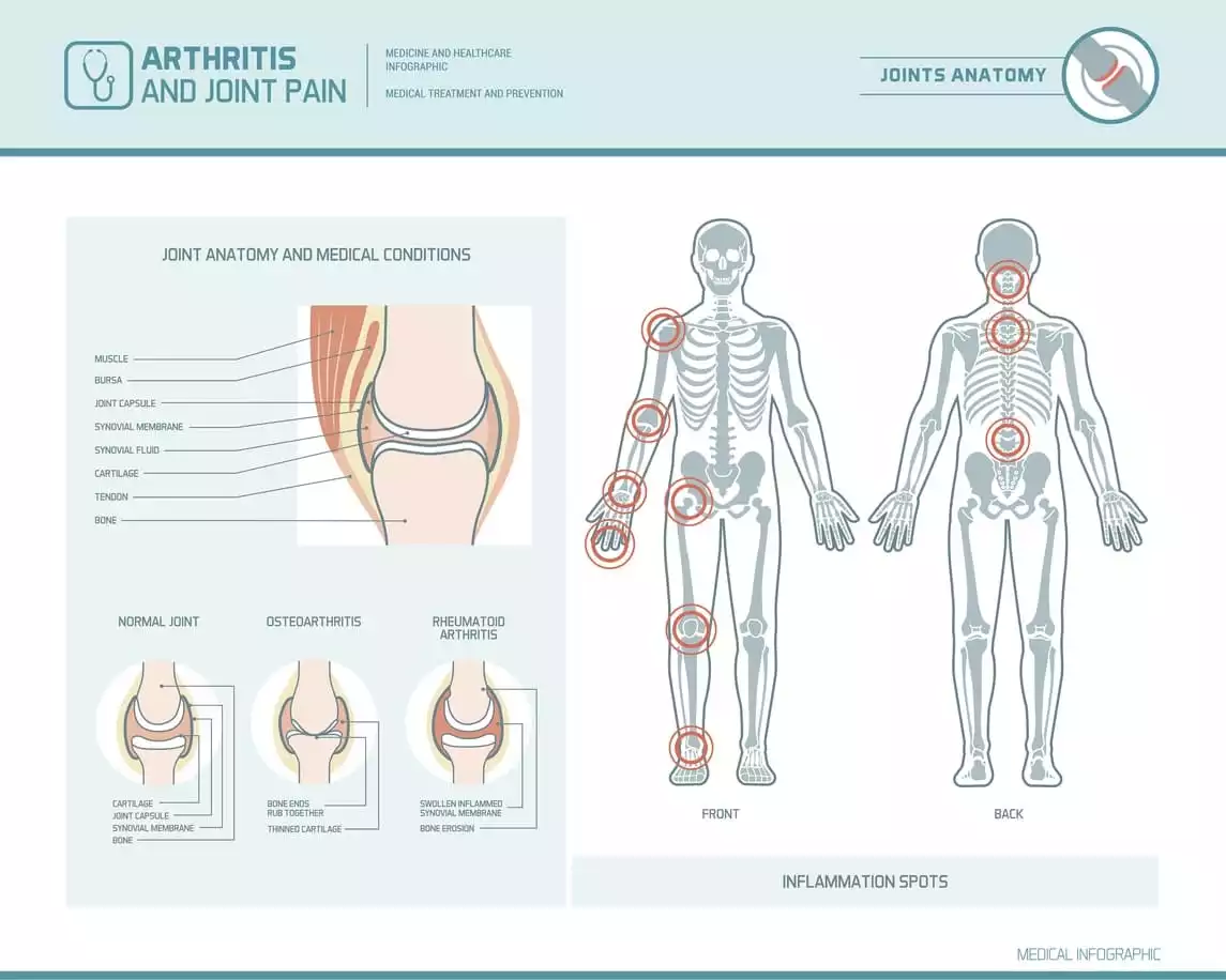 Different Types of Arthritis | Burt's Pharmacy and Compounding Lab