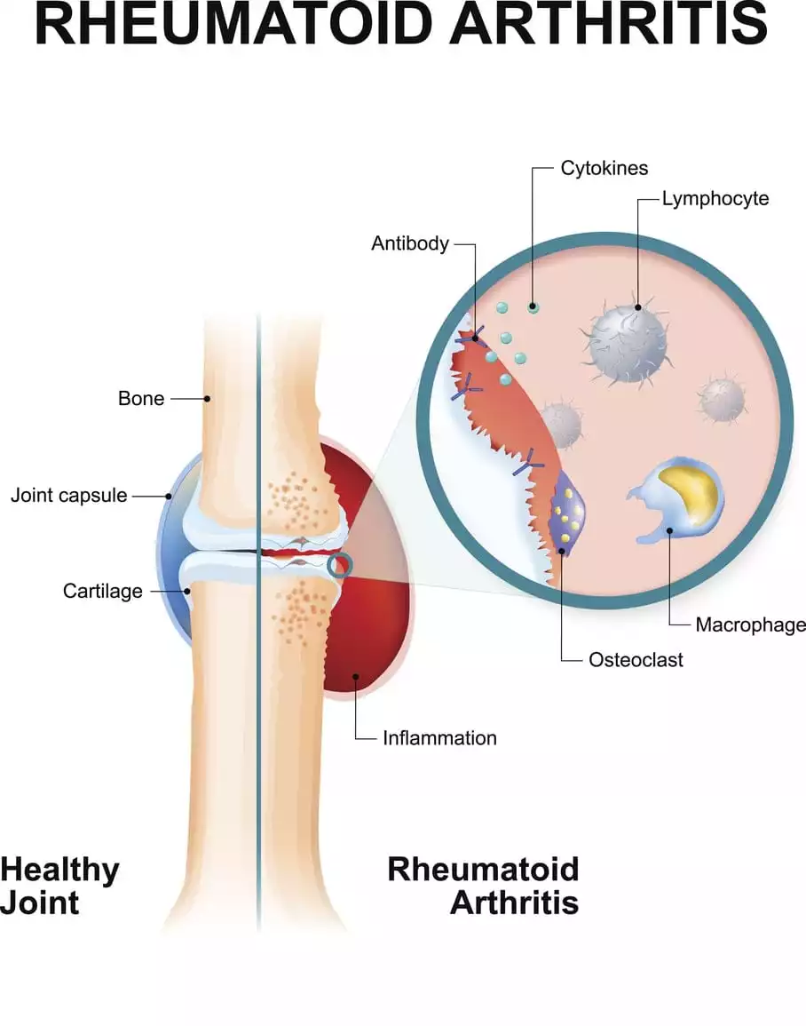 Rheumatoid Arthritis | Burt's Pharmacy and Compounding Lab