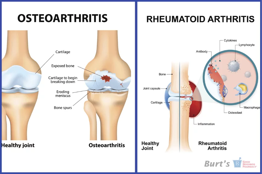How to Ease Arthritis - Burt's Pharmacy and Compounding Lab
