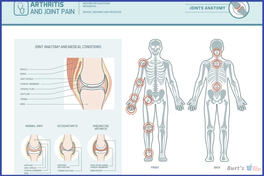 Understanding Arthritis - Burt's Pharmacy and Compounding Lab