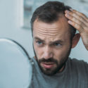 Signs of Alopecia and How to Prevent With Compounding - Burt's Rx