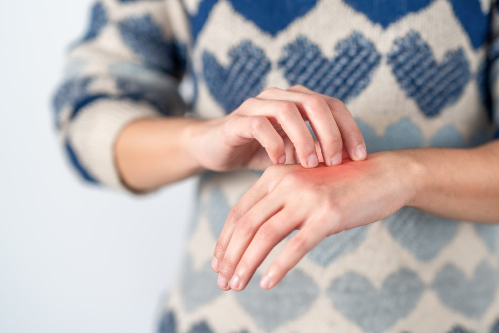 Solutions to Treat an Allergic Reaction to Medication Burt's Rx
